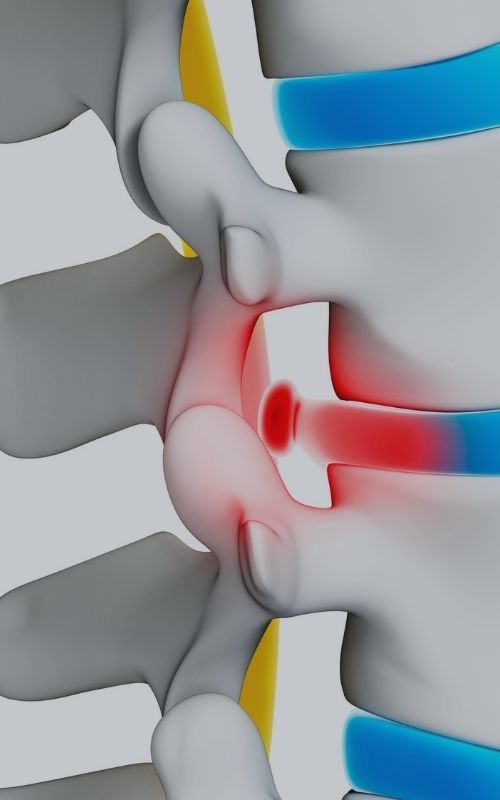 Herniated Bulging Disc Injury Lawyers in San Diego CA